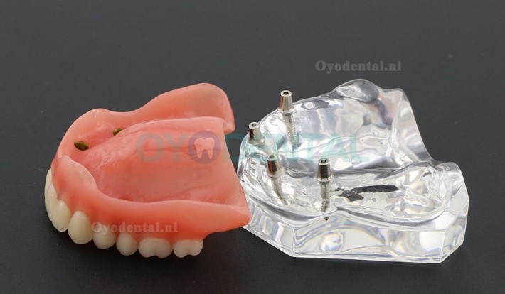 Tandheelkundige studie Tanden Model Overdenture met 4 implantaten Demo Model 6001